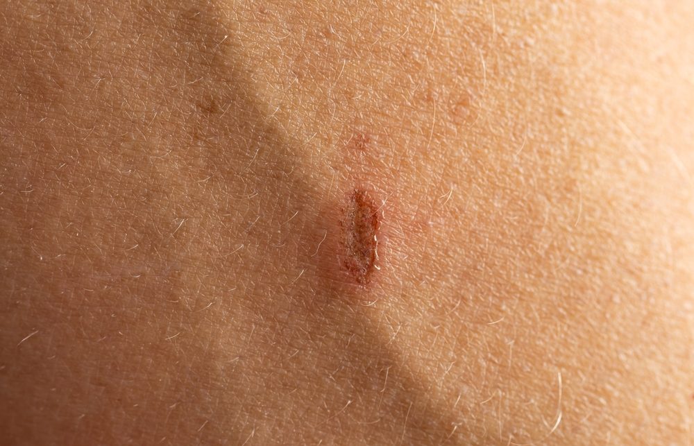 A person has a scar on their arm. The scar is red and raised