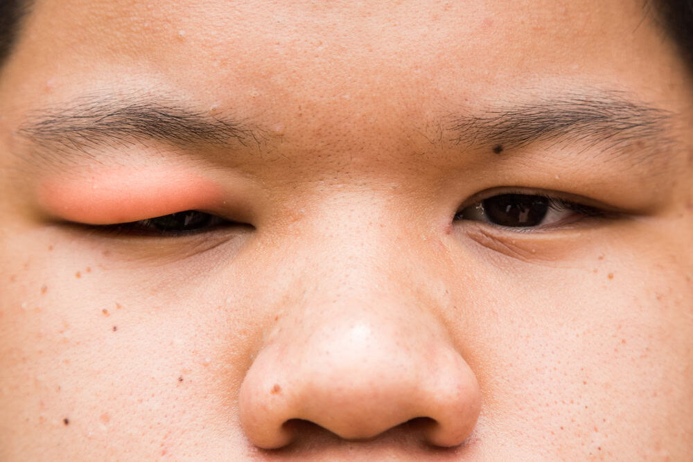 Selective focus on swollen and red upper eye lid with onset of stye infection due to clogged oil gland and staphylococcal bacteria