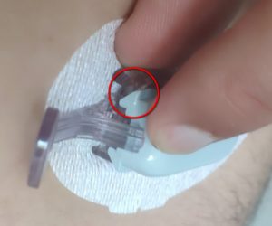 Знімання інсулінової голки з шкіри руки, використання шприца для ін'єкції.