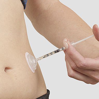 Зображення ін'єкційного порту i‑Port Advance Medtronic 6 мм, що використовується для введення інсуліну.