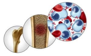 CAR-T Cell Therapy