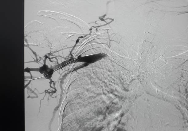 Iliac Stent