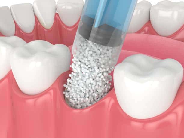 PTFE Membrane