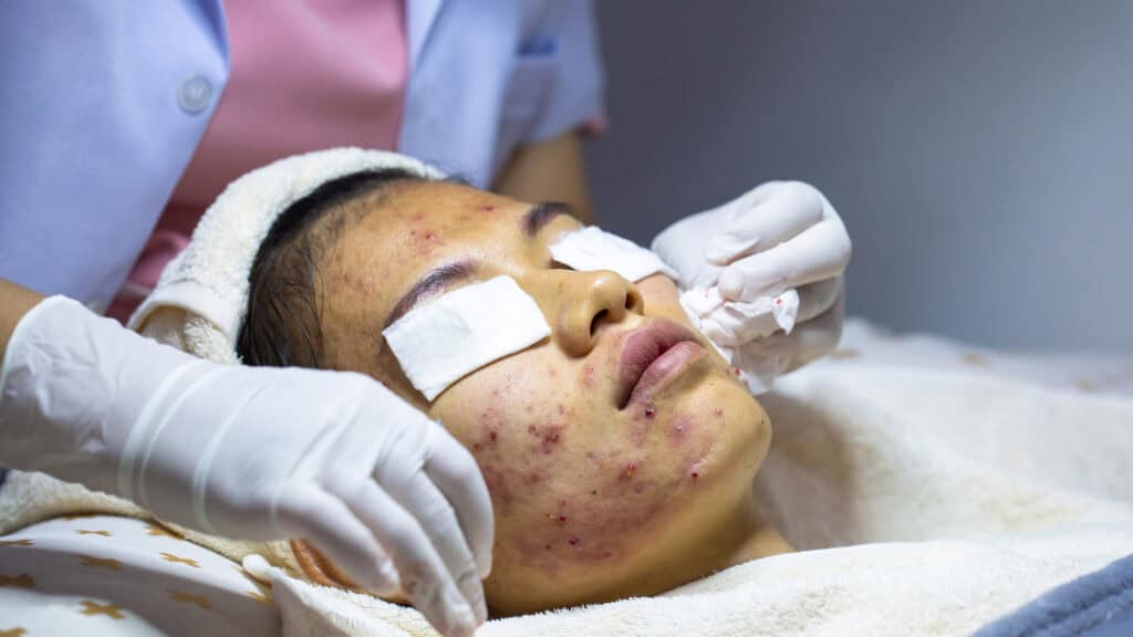 Acne Medication Market to Witness Robust Growth with Increasing Focus on Innovative Treatments and Rising Demand for Skincare Solutions