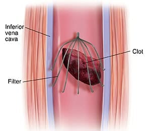 cross-section-of-inferior-vena-cava-with-filter-trapping-embolus-341711