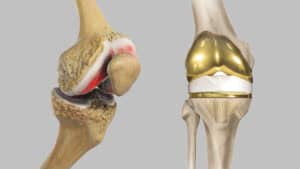 knee-replacement1