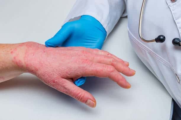 Atopic Dermatitis Treatment