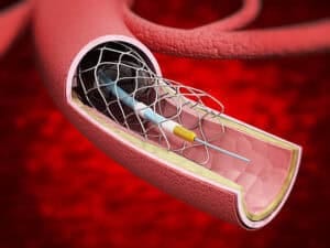 Coronary Stent