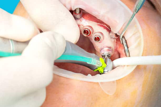U.S. Image Guided Surgery (IGS) Devices Market Outlook: Strategic Growth and Industry Insights