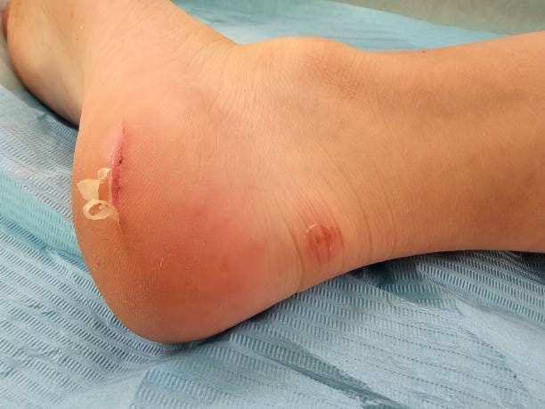 Infectious Wound Care Management