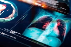 Lung Cancer Treatment Drugs