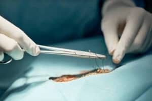 Suture Thread