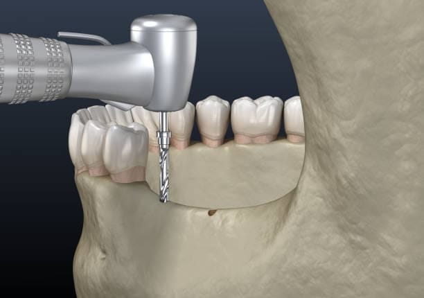 China Radial Head Resection Implants Market Spotlight: Size, Share, and Growth Trends Explored through 2035