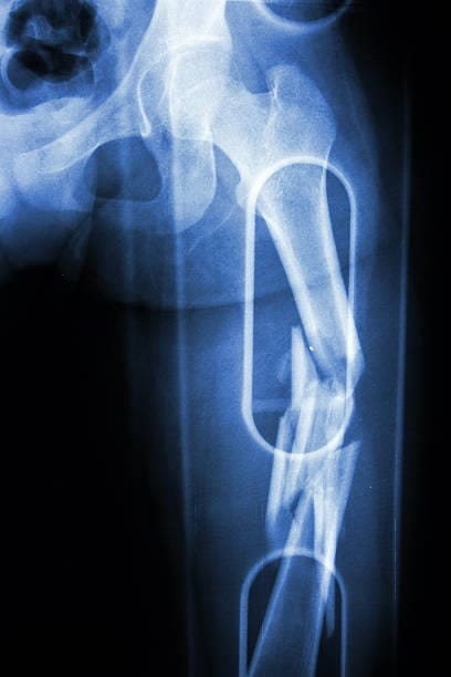 China Hip Splint Market Study: Comprehensive Segmentation and Forecast
