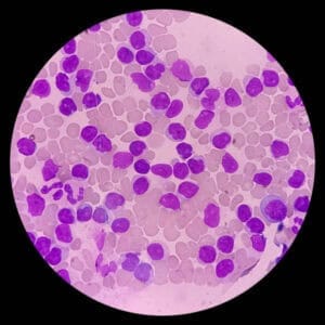 Acute LymphocytiLymphoblastic Leukemia
