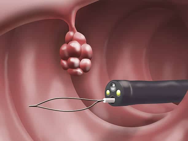 Endoscopic Mucosal Resection