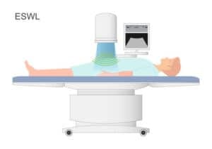 Extracorporeal Lithotripter