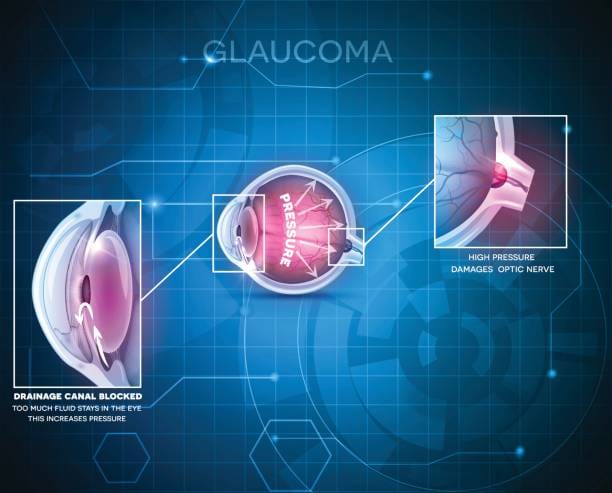 Glaucoma Therapeutics