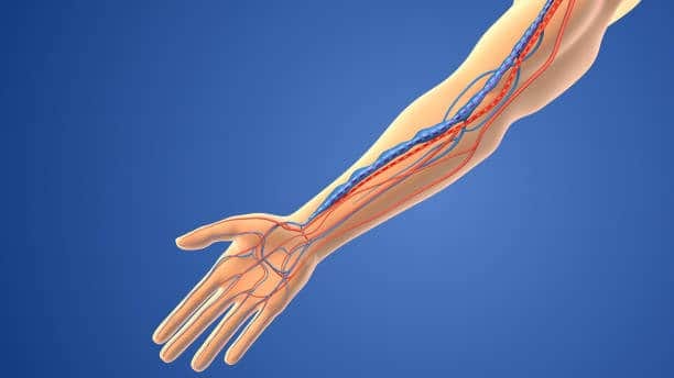 Hemodialysis Catheter