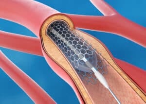 Metal Stents