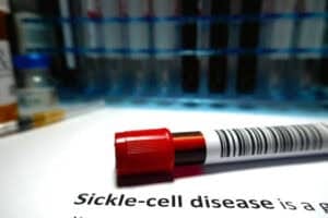 Sickle Cell Disease Treatment