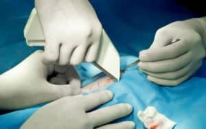 Surgical Stapler