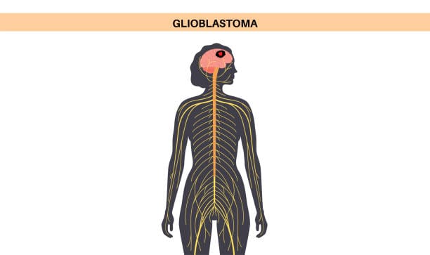 Japan Glioblastoma Multiforme Treatment Market Intelligence Report: Recession Readiness and Tariff Implications