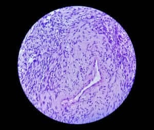 Malignant Peripheral Nerve Sheath Tumour Treatment