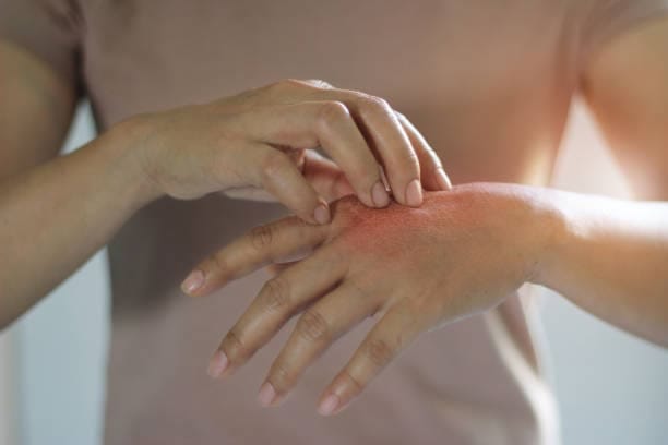 Psoriasis Drugs