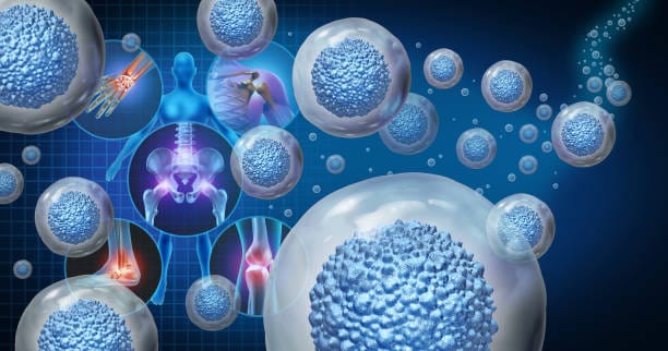 Rheumatoid Arthritis Stem Cell Therapy
