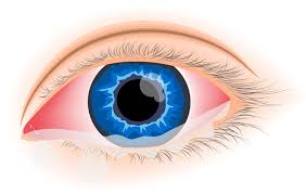 Allergic-Conjunctivitis