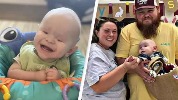 Baby born without eyes