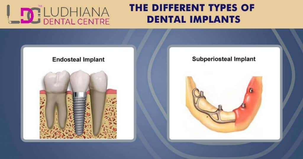 The Different Types of Dental Implants