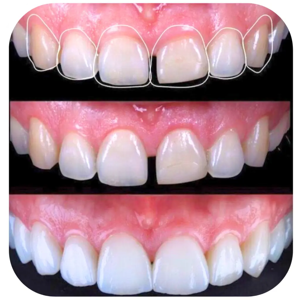 affordable dental veneers sydney
