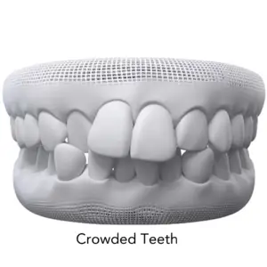crowded teeth