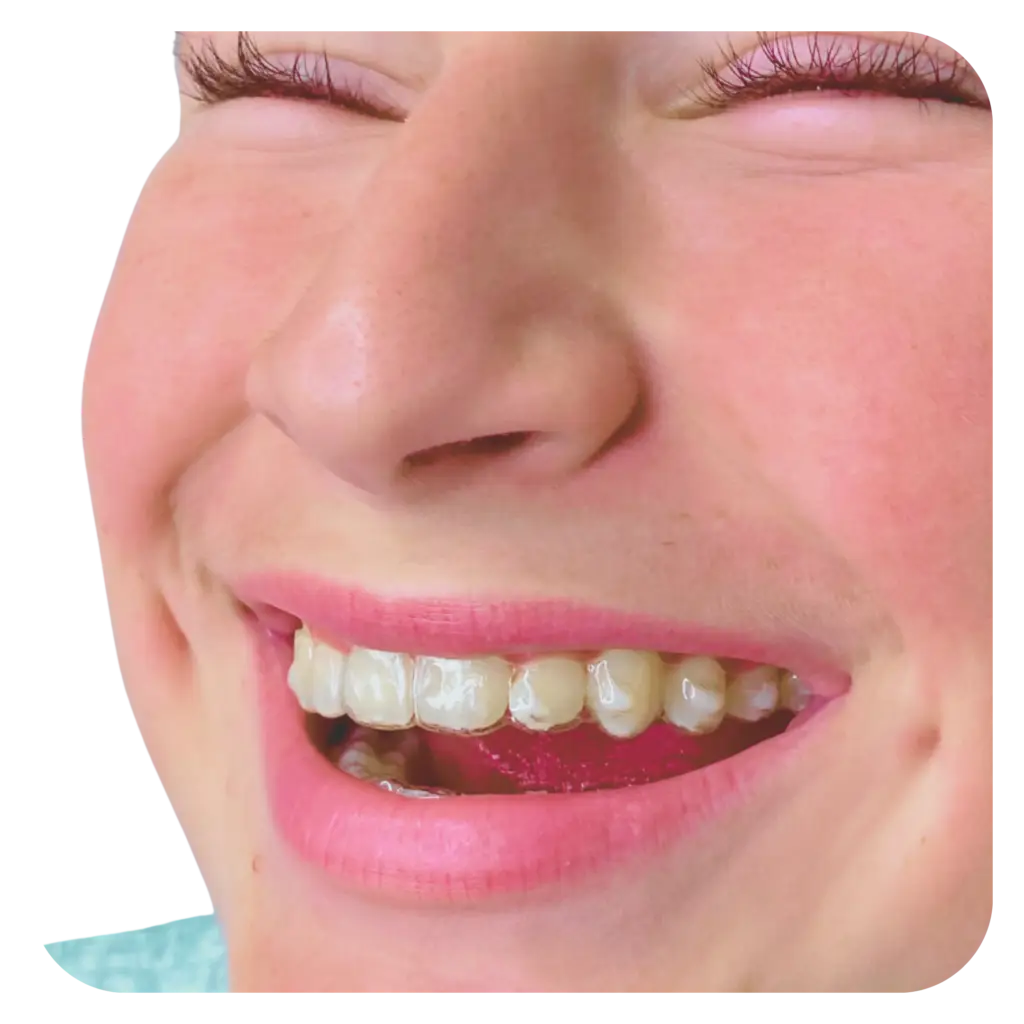 Kids Invisalign