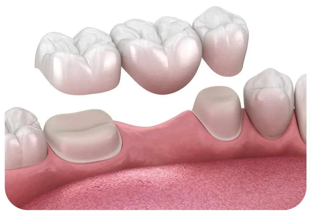 cheap dental crowns sydney