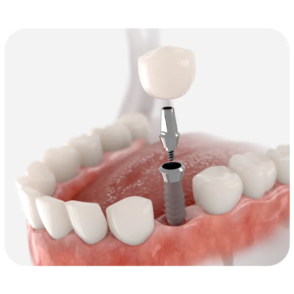 cheap dental implant sydney