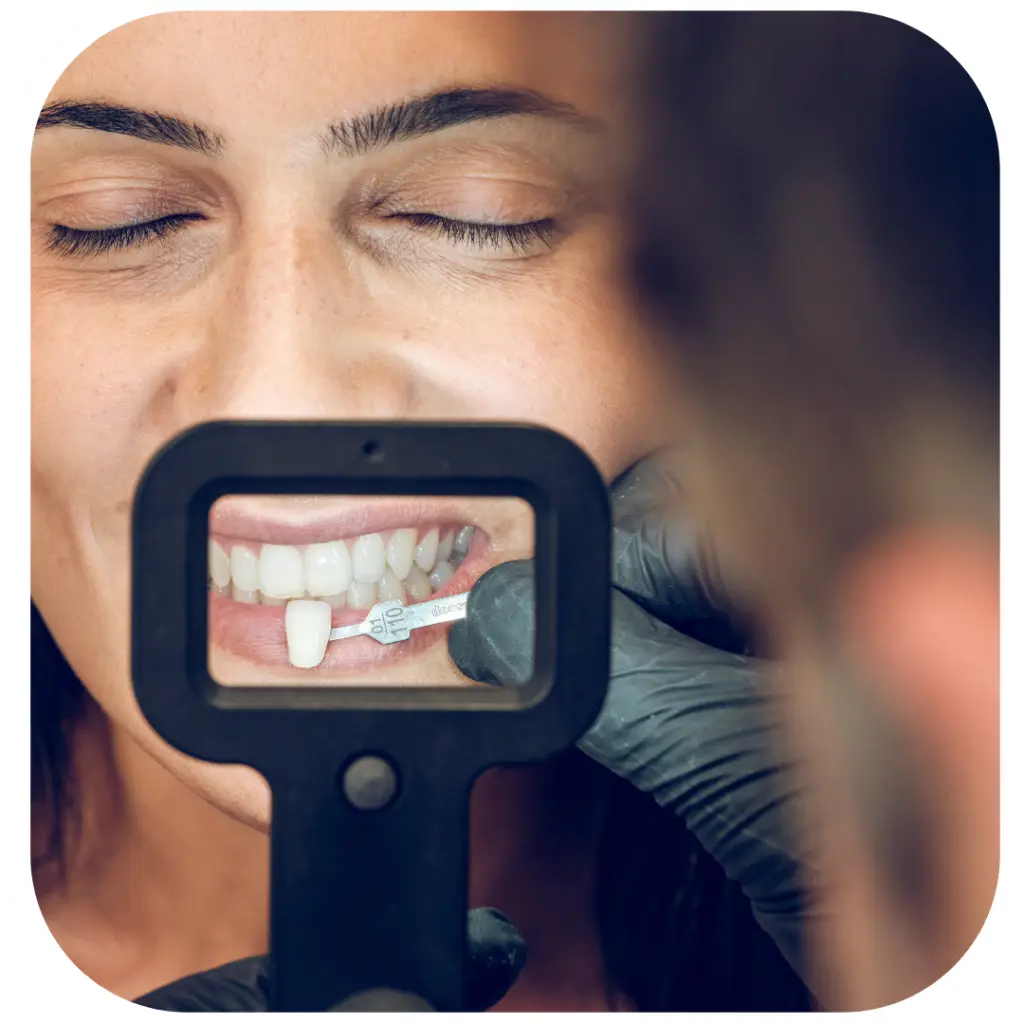 dental veneers sydney