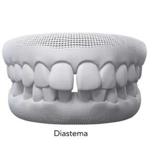 diastema