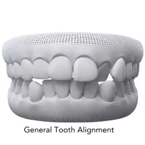 general tooth alignment