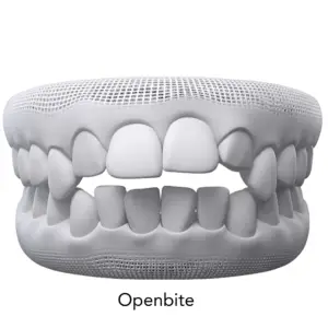openbite