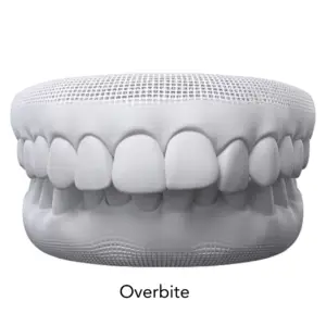 overbite