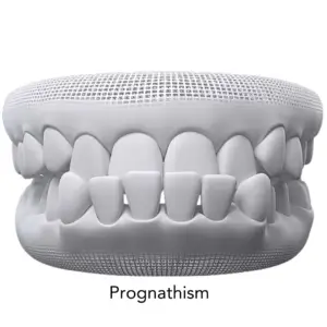prognathism