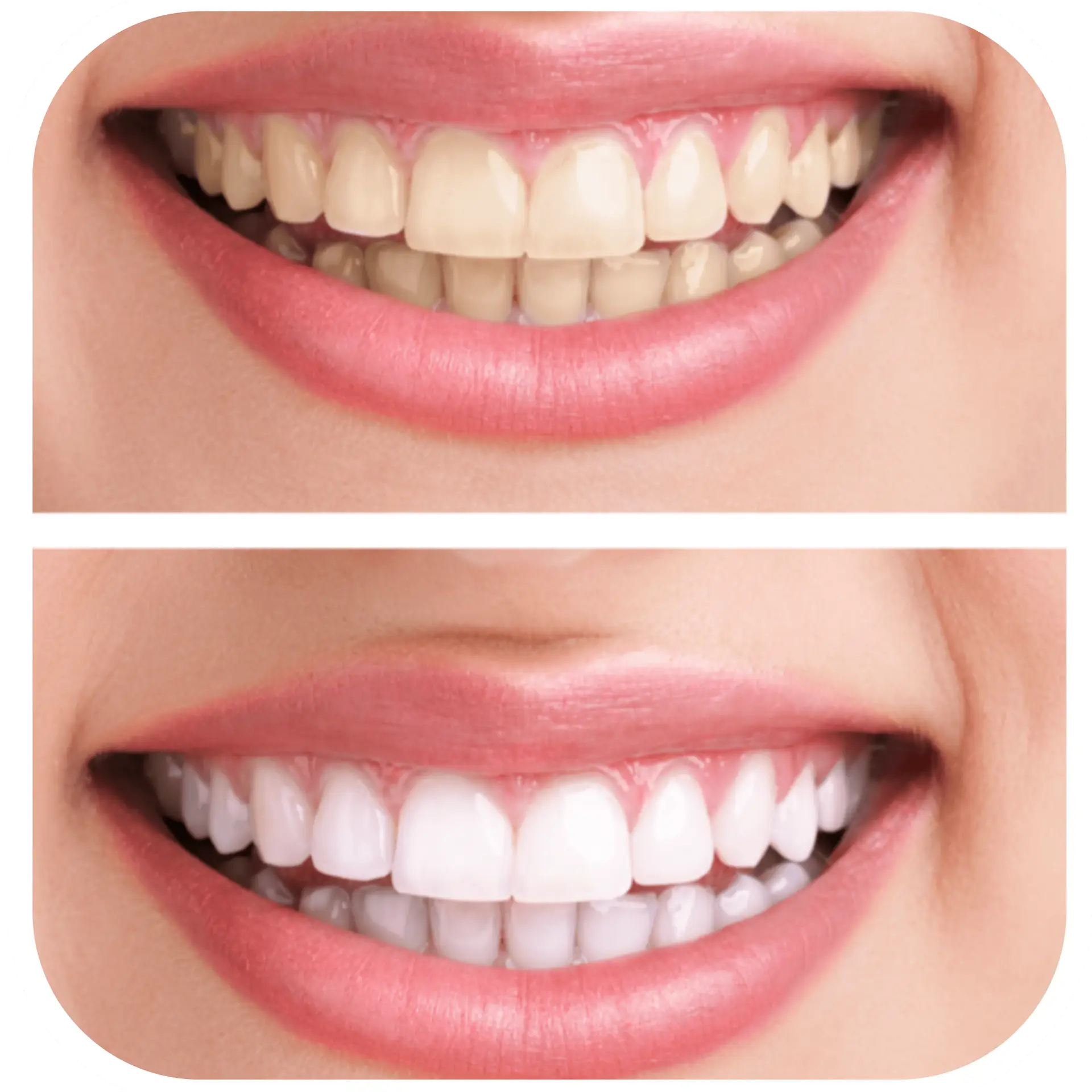 teeth whitening