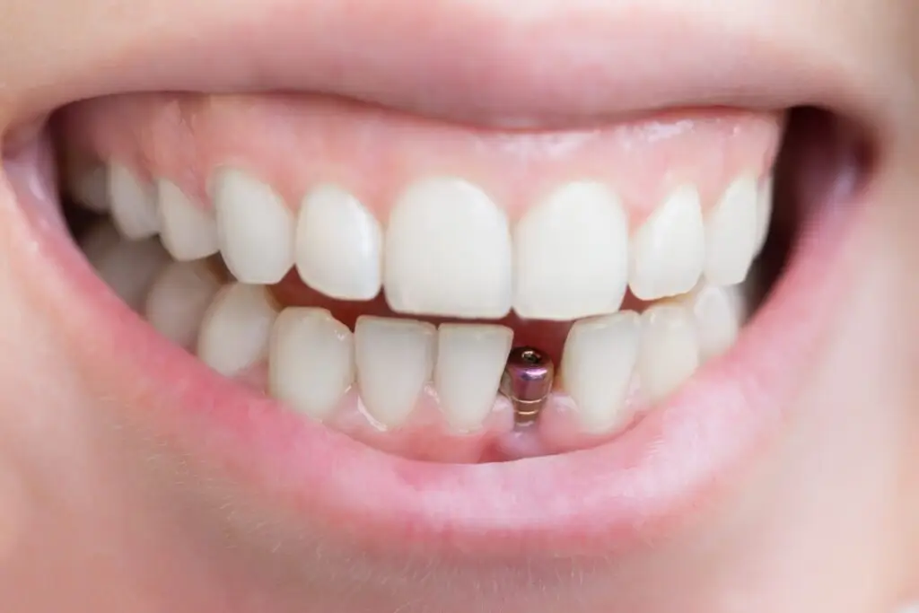 Dental Implant3