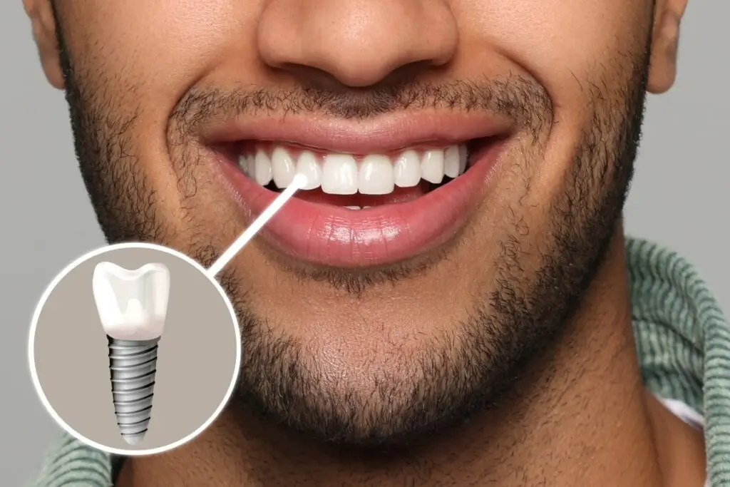 Dental Implants1