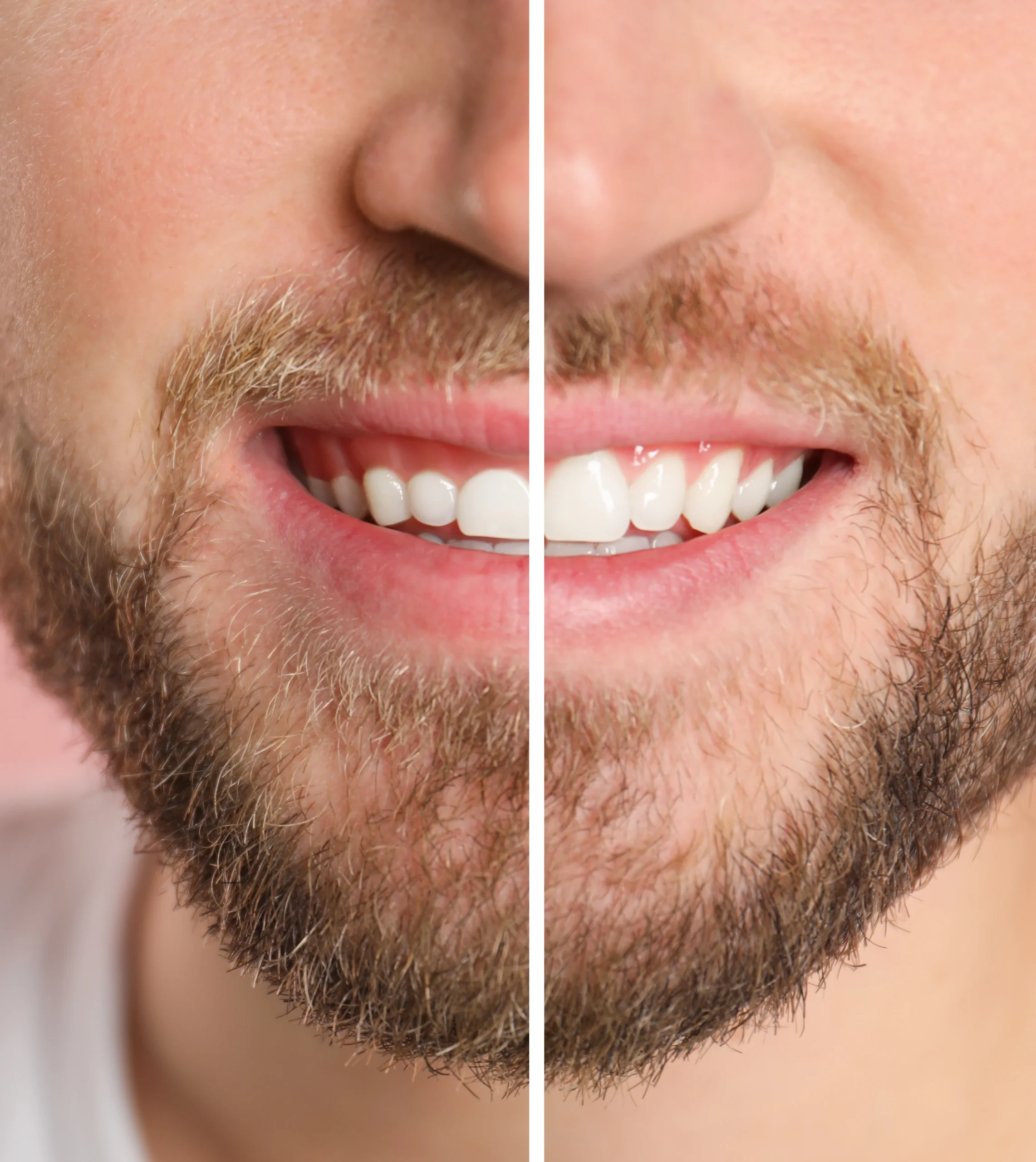 Gum Surgery 5 scaled