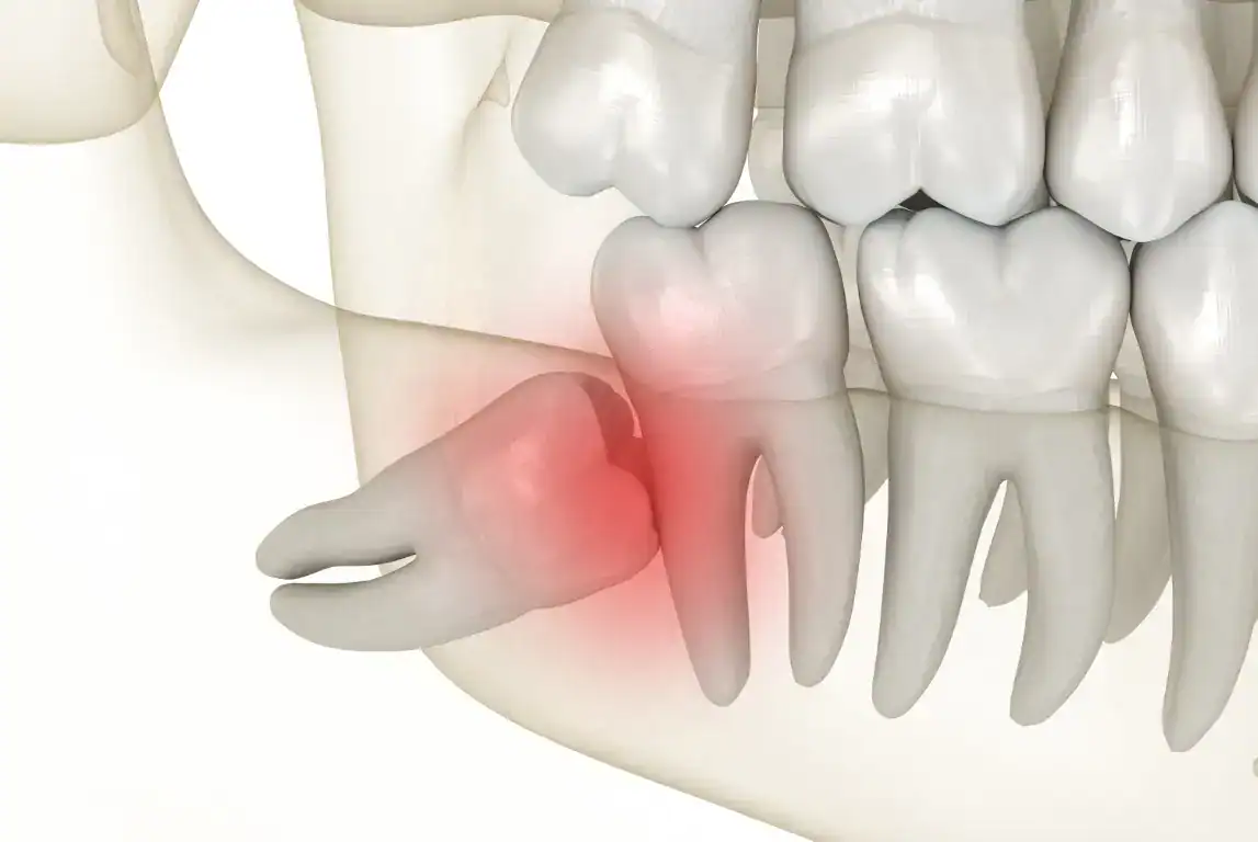 Wisdom tooth removal 2