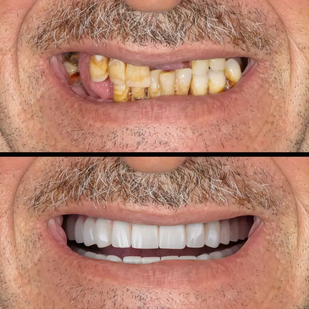 All-on-4 Dental Implants in Sydney